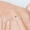 Skin Cancer Treatment: Mohs Surgery