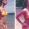 breast augmentation