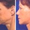 facelift