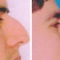 nose job