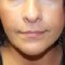 Filler-Before