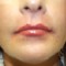Filler-After