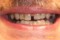 Cosmetic Dentistry picture Before Porcelain Crowns