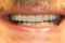 Cosmetic Dentistry picture After Porcelain Crowns