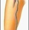 Endovenous Laser Treatment