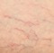 Human Spider Veins on Leg Closeup