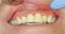 "Mr. P" in temporary crowns