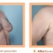 Breast Reduction