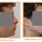 Rhinoplasty