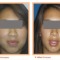 Rhinoplasty