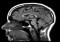 Brain Injury
