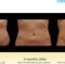 Coolsculpting