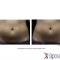 Liposonix