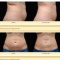 CoolSculpting Before and After Pictures