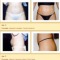  Liposuction (Lipoplasty / Suction Lipectomy) Before and After Pictures