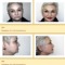 Face Lifts (Rhytidectomy) Before and After Pictures