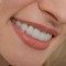 Veneers